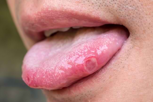 Ragam pilihan obat sariawan di lidah
