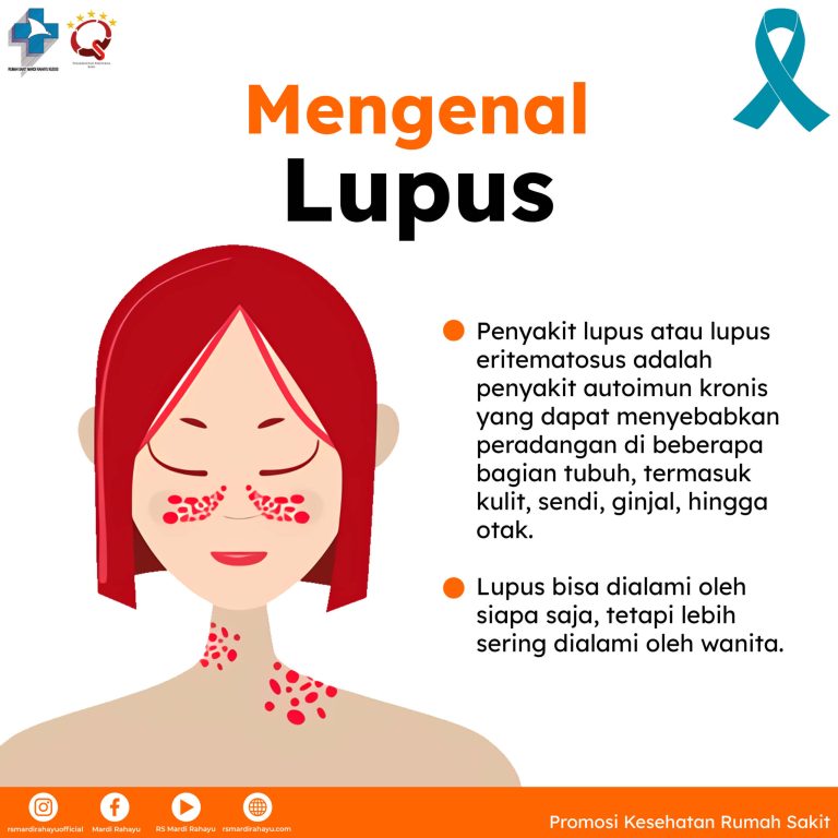 Perempuan lebih rentan terkena penyakit lupus dibandingkan pria