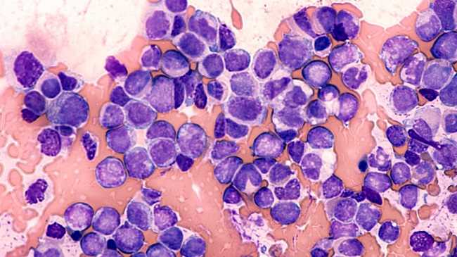 11 gejala kanker darah yang umum terjadi