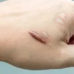 Cara efektif hilangkan bekas luka 
